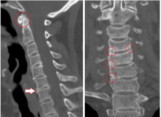 CT zeigt beschädigte Wirbel und Bandscheiben von heterogener Höhe aufgrund von thorakaler Osteochondrose