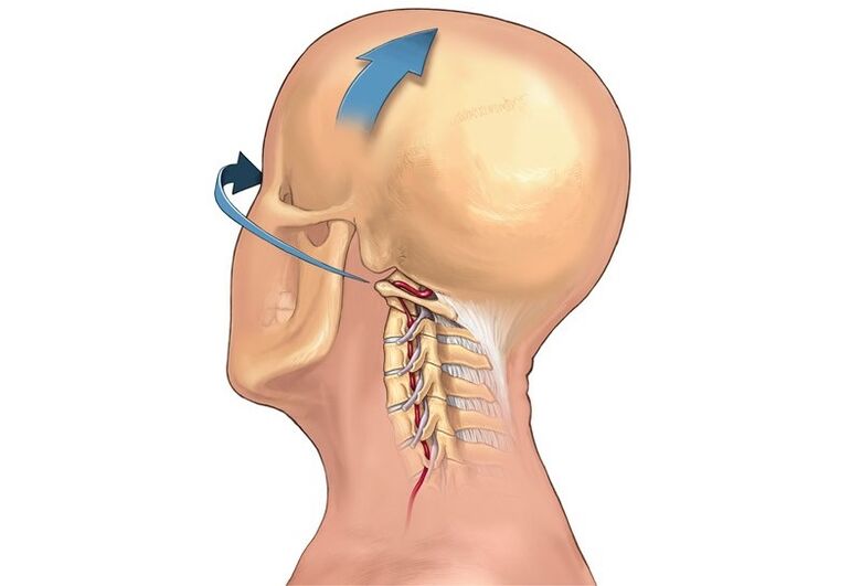 Knirschen im Nacken beim Drehen des Kopfes als Symptom einer zervikalen Osteochondrose