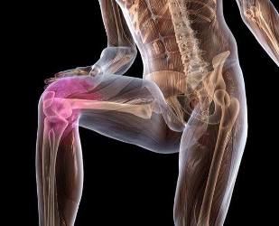 Entzündung des Kniegelenks mit Arthrose