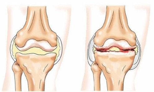 gesundes Kniegelenk, das von Arthrose betroffen ist