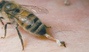 Behandlung der Hüftarthrose durch Bienen