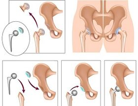 Endoprothese bei Arthrose des Hüftgelenks