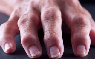 rheumatoide Arthritis als Ursache von Gelenkschmerzen